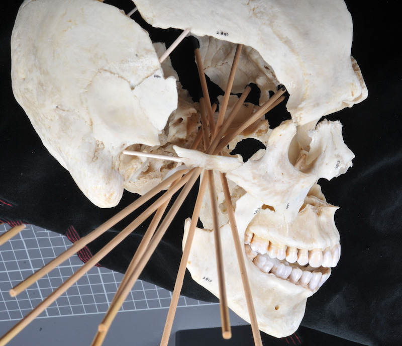 Thin wooden dowels are inserted into Pat’s reconstructed skull to show gunshot trajectories
