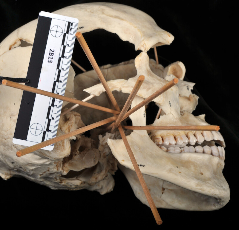 Thin wooden dowels are inserted into Pat’s reconstructed skull to show gunshot trajectories